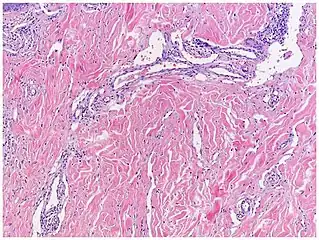 Micrograph of promontory sign in Kaposi's sarcoma in patch stage. Dilated irregular vascular channels surround a pre-existing vessel.[15]