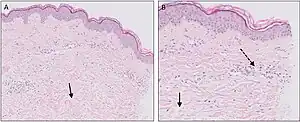 Micrograph of urticaria. Dermal edema [solid arrows in (A,B)] and a sparse superficial predominantly perivascular and interstitial infiltrate of lymphocytes and eosinophils without signs of vasculitis (dashed arrow).[29]