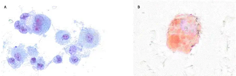 Bronchoalveolar lavage sample from a patient with acute lung injury associated with vaping, showing alveolar macrophages laden with vacuoles (A) and extensive lipid deposits (B)[59]