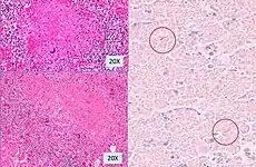 Histopathology, showing epithelioid granulomas with multinucleated giant cells and acid-fast bacilli