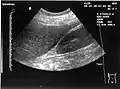 Ultrasonographic view of the abdomen demonstrating fluid within Morison's pouch