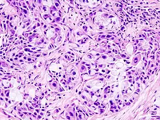 Histopathologic image of mucoepidermoid carcinoma of the major salivary gland. The same lesion as shown in a filename "Mucoepidermoid carcinoma (2) HE stain.jpg". H & E stain