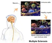 Multiple sclerosis