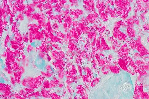 Histopathology of tuberculosis of the duodenum. Numerous rod shaped tuberculosis bacilli can be seen.