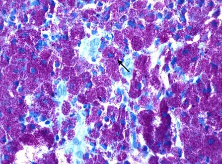 Rod-shaped bacilli with Kinyoun AFB stain shown densely packed within histiocytes, consistent with Mycobacterium avium complex