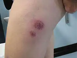 Mycobacterium chelonae abscesses associated with biomesotherapy, an alternative therapy practice. (The abscesses are at the biomesotherapy injection site).