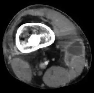 Mycobacterium doricum osteomyelitis and soft tissue infection. Computed tomography scan of the right lower extremity of a 21-year-old, showing abscess formation adjacent to nonunion of a right femur fracture.
