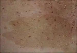 Neurofibromatosis type I café au lait spot