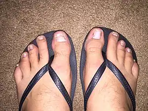 A photograph showing the effects of psoriasis on the toenails