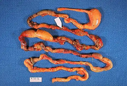 Alimentary tract of infant showing intestinal necrosis, pneumatosis intestinalis, and perforation site (arrow). Autopsy.