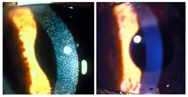 Slit-lamp photographs of three-year-old patient with nephropathic cystinosis before (left) and after (right) cysteamine eyedrop therapy. The drops dissolve the crystals in the cornea.