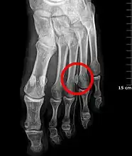 Xray of Morton's neuroma