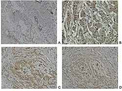 Neuropilin-2 expression in normal breast and breast carcinoma tissue.