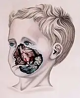Noma (sketch from 1836)