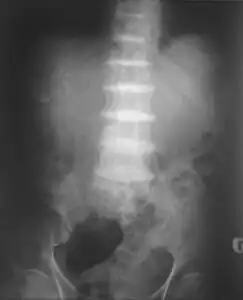 Intervertebral discs calcification due to ochronosis]]