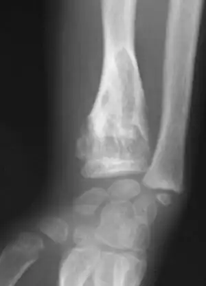 X-ray wrist: Ollier disease in child