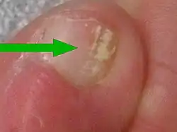 Fungal nail infection