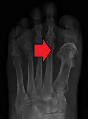 Osteomylitis of first toe