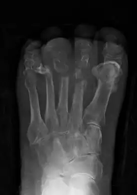 Extensive osteomyelitis of the forefoot