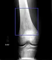 Osteosarcoma of the distal femur