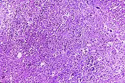 This photomicrograph of a hematoxylin-eosin (H&E) stained tissue sample of cervical spinal cord, reveals how it was affected by the polio type-III virus.
