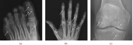 a-c)Osteopoikilosis in feet, hand, knee