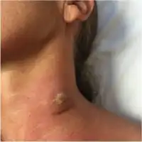 Chancre of human African trypanosomiasis[14]