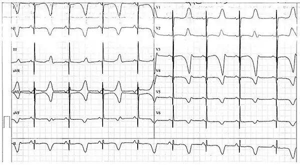ECG from a 10-year-old boy with Jervell and Lange-Nielsen syndrome