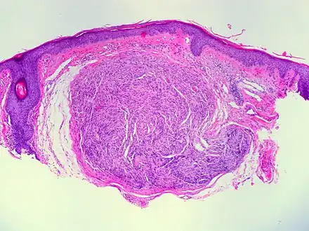Palisaded and Encapsulated Neuroma