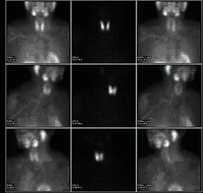 A nuclear medicine parathyroid scan demonstrates a parathyroid adenoma adjacent to the left inferior pole of the thyroid gland. The above study was performed with Technetium-Sestamibi (1st column) and iodine-123 (2nd column) simultaneous imaging and the subtraction technique (3rd column).