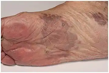 Patch stage Kaposi's sarcoma. Red to brownish irregularly shaped macules and plaques.[15]