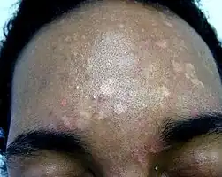 Pityriasis versicolor