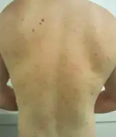 Pityriasis rosea on back