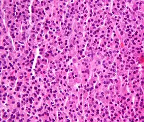 Micrograph of a plasmacytoma.