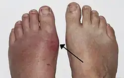 Gout of the left MP joint of the big toe