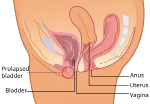 Cross sectional view of bladder prolapse