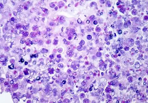 Photomicrograph of Prototheca wickerhamii infection in a human. Note the floret-like arrangements. Hematoxylin and eosin stain.