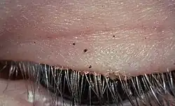 Pubic lice on the eyelashes