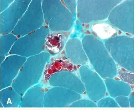 An example of ragged red fibers