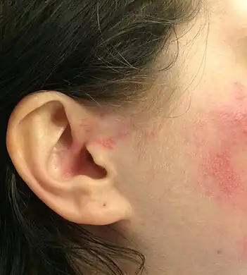 Small blisters in and around the ear in Ramsay Hunt syndrome type 2