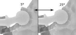 Acetabular anteversion is normally between 5 and 25°. An anteversion below or above this range increases the risk of dislocation. There is an intra-individual variability in this method because the pelvis may be tilted in various degrees in relation to the transverse plane.