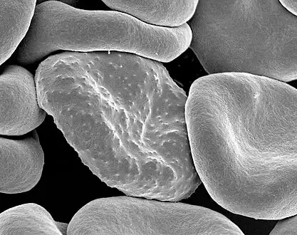 Electron micrograph of a Plasmodium falciparum-infected red blood cell (center), illustrating adhesion protein "knobs"