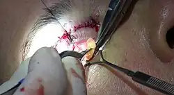 The fat is excised (cut away) with surgical scissors.