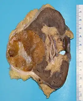 Gross appearance of the cut surface of a nephrectomy specimen containing a renal oncocytoma. Note the rounded contour, the mahogany colour and the central scar.