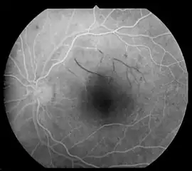 Emptied retinal venules due to arterial branch occlusion in diabetic retinopathy