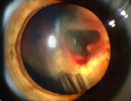 Slit lamp photograph showing retinal detachment in Von Hippel–Lindau disease