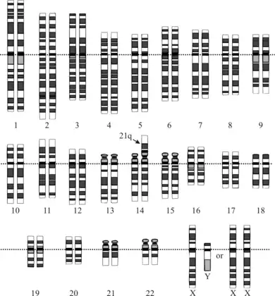 Translocation karyotype for Down syndrome with 14/21 Robertsonian translocation. Notice the three copies of 21q (two chromosomes 21 and the long arm of chromosome 21 fused to the short arm of a chromosome 14).