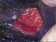 Granulome inguinale on a vulva