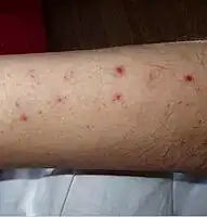 Numerous spots of bleeding into the skin of the leg in a person infected with T. b. rhodesiense[15]