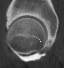 Sagittal CT-arthrography showing posteroinferior chondral injury.